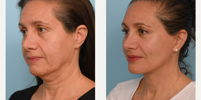 Woman treated with Facelift - This patient of ours in her mid 50s came in for a consultation wanting an overall refreshed look. Therefore Dr. Balikian performed a Customized Deep Plane Face and Necklift.
