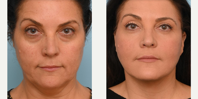45-54 year old woman treated with Facelift - This patient in her early 50s was interested in facial rejuvenation of her face and neck. Dr. Balikian performed a customized deep plane face and neck lift, upper and lower eyelid rejuvenation and facial fat transfer.Our patient is now 3 months from her facial rejuvenation, and she is thrilled with her cosmetic results!