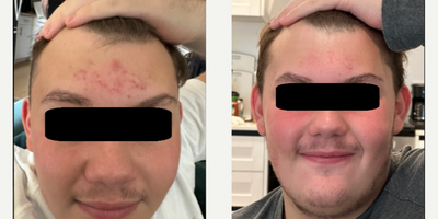 18-24 year old man treated with Retin-A - Retin-A works by promoting the turnover of skin cells, which helps to prevent the clogging of pores and reduce the formation of acne lesions. It can also help to reduce the appearance of fine wrinkles and mottled skin discoloration, and to make rough facial skin feel smoother.While Retin-A can be very effective, it can also cause side effects, including skin redness, dryness, itching, scaling, mild burning, or worsening of acne during the first 2 to 4 weeks of using the medication. These side effects usually decrease with continued use of the medication.It's important to use Retin-A exactly as directed by your physician and to avoid exposure to sunlight or artificial UV rays, such as sunlamps or tanning beds, while using the medication, as it can make your skin more sensitive to UV rays.