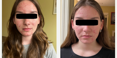 12 year old woman treated with Accutane - Accutane, also known by its generic name isotretinoin, is a medication primarily used to treat severe acne, specifically nodular or cystic acne that hasn't responded to other treatment methods. It belongs to a class of drugs known as retinoids, which are derivatives of Vitamin A.Treatment Process:The treatment length with Accutane varies typically from 16 to 20 weeks. During this time, patients take one or two pills daily with food. The dosage is determined by the patient's body weight and the severity of the acne.