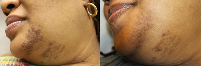 Aerolase Neo for Ingrown Hair - Aerolase Neo for ingrown hair 4 weeks post op first session.