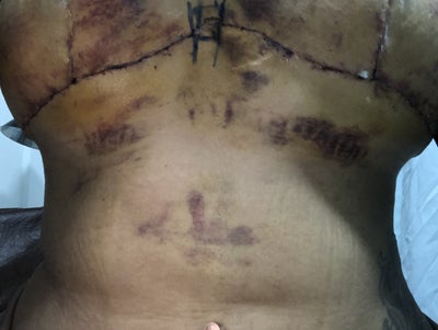 I look 'butchered after botched' £3,500 tummy tuck left me with giant  hip-to-hip scar