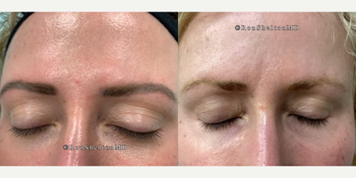 35-44 year old woman treated with PicoSure, Tattoo Removal - Patient wasnt happy with the color of her eyebrow tattoo due to her sparse eyebrow hairs, so the result shows mostly her natural hair growth. She can either use an eyebrow pencil, leave them as they are, or get them re-tattooed in a different color.2nd pair of photos - Previously,  tattooist used different metals in her dark brown tattoo, so when we applied the first laser treatment with a 1064nm wavelength to reduce the dark brown, it revealed red and yellow tones from the enhancers. The advantage of seeing a laser specialist is having access to multiple lasers and wavelengths, allowing us to use a different wavelength to target the red and yellow colors, which many practices cant do. In the second treatment, we effectively removed the red-brown color using a PicoPlus 532nm wavelength.