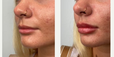 18-24 year old woman treated with Lip Fillers, Revanesse - patient injected with one syringe of revanesse lips