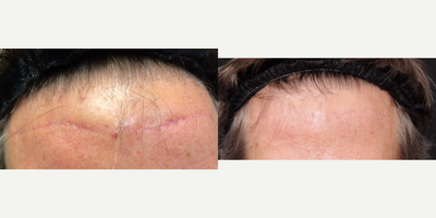 65-74 year old man treated with Fractional Non ablative Laser - 72y/o with forehead scar who desired scar treatment