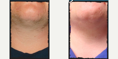 Man treated with Laser Hair Removal - Man treated with Laser Hair Removal.