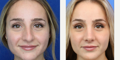 Woman treated with Rhinoplasty - Woman treated with Rhinoplasty