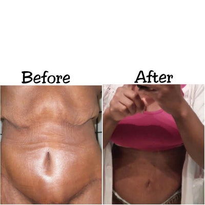 Bra Line Back Lift Before and After in Chicago IL