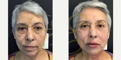 Woman treated with Liquid Facelift - Woman treated with Liquid Facelift