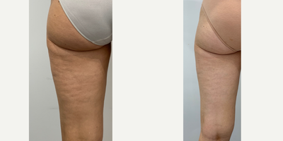 35-44 year old woman treated with Emtone - Amazing results after 4 treatments of Emtone