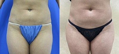 Woman treated with Hip Augmentation - Woman treated with Hip Augmentation