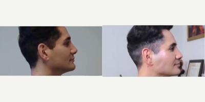 Man treated with Vampire Facial - I treated this patient with a Profound Vampire Facial using PRP and extreme micro needling. It eliminated acne scaring, stimulated collaged for a dewey look, and enhanced color and skin cell production.
