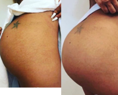 Woman treated with Nonsurgical Butt Augmentation - Woman treated with Nonsurgical Butt Augmentation through microneedling and PRP to diminish stretch marks and cellulites while lifting and tightening the buttocks.