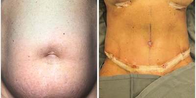 Woman treated with Tummy Tuck - On table result!Swipe to see the Before!Stay tuned for an updated B + A photo comparisonAge: 47Procedure: Tummy tuck + Breast AugmentationGoal Flat tummy + Lifted bust