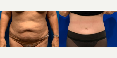 Woman treated with Tummy Tuck - Woman treated with Tummy Tuck
