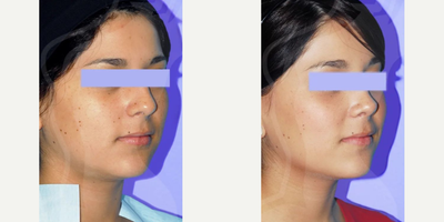Woman treated with Rhinoplasty - Subtle changes that make a big impact on our patients' confidence and self-esteem.Procedure: Rhinoplasty