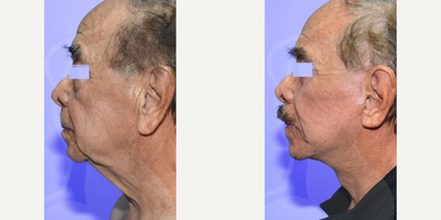 Man treated with Chin Implant, Facelift - Men also want to look and feel better.Procedures: Low Rhytidectomy (Cavity/Jaw/Neck) + Blepharoplasty + Chin Implant