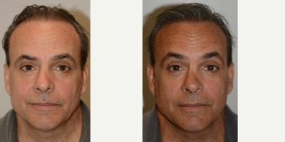 55-64 year old man treated with NeoGraft - NeoGraft Procedure