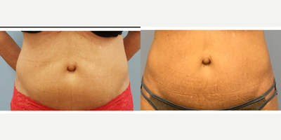 35-44 year old woman treated with Laser Treatment - Treated with Body FX laser contouring system.