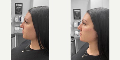 25-34 year old woman treated with Chin Filler - Looking to subtly add more definition to her cheeks and jawline, this patient opted for dermal fillers. After photos were taken immediately following treatment.