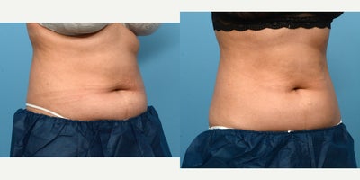 25-34 year old woman treated with Cryolipolysis - This 25-year-old patient was treated with one session of CoolSculpting for the abdomen. Six months post-procedure, she's thrilled with the amount of fat reduction in her mid-section and how much better her clothes fit.