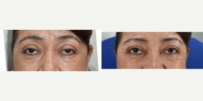 55-64 year old woman treated with Skin Rejuvenation - Heavy eyelids are considered attractive by some.  For others (many of our patients), they are not.  If you want to brighten up your eyes, Upneeq is a great way to do it.  It works by contracting the muscle that lifts the upper lid.  Call us today to learn more about the product.