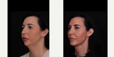 35-44 year old woman treated with Neck Lift, Rhinoplasty, Chin Implant, Facial Fat Transfer - Our patient is 9 months out from a deep neck lift, chin implant, rhinoplasty, and facial fat grafting and she is healing beautifully! Thank you to her for allowing us to share!