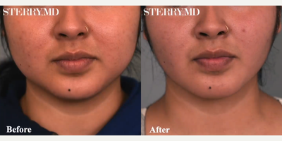 Woman treated with Buccal Fat Removal - Woman treated with Buccal Fat Removal for chubby cheeks reduction as well as Cheek and Chin/Neck Liposuction for double chin removal