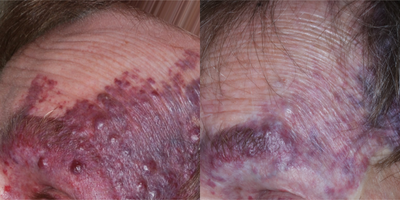 55-64 year old man treated with Excel V - 66-year-old male, with port wine stain left forehead, 6 months status post approximately 15 treatments with various vascular lasers over 8 years.