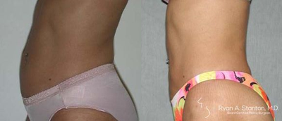 Woman treated with Tummy Tuck - Woman treated with Tummy Tuck