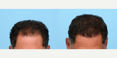35-44 year old man treated with FUE Hair Transplant, Hair Transplant, Hair Loss Treatment, PRP for Hair Loss - This 40-year-old patient underwent an FUE hair transplant, during which Dr. Wise transplanted 3,020 grafts to restore this patient's hairline and add density. He also did one treatment of PRP therapy to strengthen the follicles. His results are shown one year post-op.