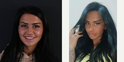 18-24 year old woman treated with Canthoplasty - our patient has been treated with cat eyes + brow lift