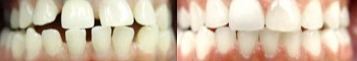 18-24 year old woman treated for Braces - Correction of spacing with braces