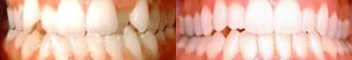 35-44 year old man treated for Braces - Correction of overbite with braces