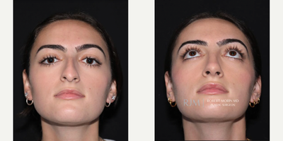 Woman treated with Rhinoplasty - Woman treated with Rhinoplasty