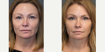Upper and Lower Eyelid Surgery - Upper and lower eyelid surgery with laser.