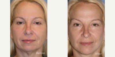 Facelift, Advanced Facelift - Advanced Facelifting techniques used. Performed under local anesthesia.
