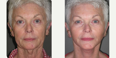 65-74 year old woman treated with SMAS Facelift - This woman with fair skin and years of sun exposure wished for improvement of her lower half of her face along with her neck.  Specifically, she wished for a tighter feel of her skin and some reduction of her wrinkles.  We performed a SMAS lower facelift where both the underlying muscle and skin were tightened.  This allowed her to achieve a result where the feel, shape, and appearance of her lower face and neck were significantly improved while still maintaining a natural healthy appearance.