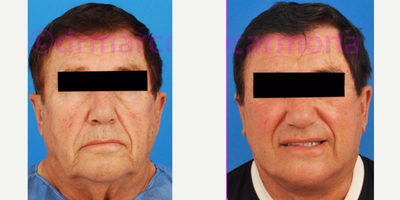 75 and up year old man treated with MACS Facelift - Macslift, procedure, necklift