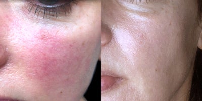 25 year old female treated with Pulsed Dye Laser - This patient wanted to address redness due to rosacea. She underwent a series of 5 vascular laser treatments with Dr. Khorasani.