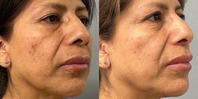 Lumecca IPL Full Face - Lumecca IPL effectively targets and diminishes sun damage, age spots, and vascular lesions with its powerful intense pulsed light (IPL) technology, significantly improving skin tone and texture. After just three treatments, notable results can be seen within two weeks, revealing a clearer and more rejuvenated complexion.