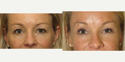 45-54 year old woman treated with Eyelid Surgery - 45 yo after endoscopic brow lift and upper blepharoplasty 6 months