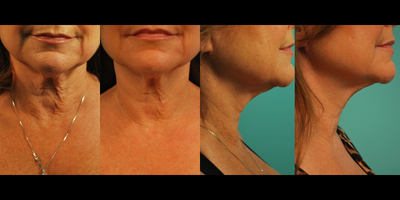 55-64 year old woman treated for Exilis - Laser Exilis was used to tighten the skin on her neck
