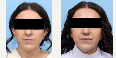 25-34 year old woman treated with Rhinoplasty - Dr. Wise performed a rhinoplasty on this patient to smooth the dorsal hump, deproject her nose and turn up the tip.