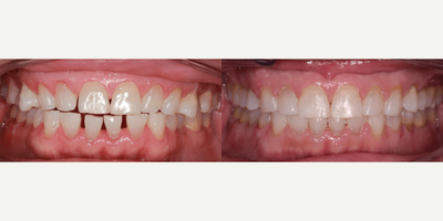 Adult Female Patient with Spacing and Edge to Edge Bite - Age: over 60Gender: FemaleProcedure: Clear Ceramic BracesThis adult female patient came to us with generalized spacing, and an edge to edge bite. The bite problem combined with her history of Bruxism (grinding) has led to the excessive wear on her teeth. The dentist treated her with Clear braces for 21 months.