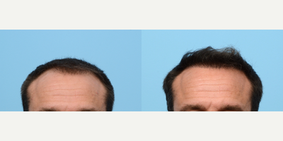 35-44 year old man treated with FUE Hair Transplant, Hair Transplant, Hair Loss Treatment, PRP for Hair Loss, NeoGraft - Age: 43Goals: Rebuild hairline, create more density in zones 1 and 2.Procedure: FUE and PRPGrafts: 3,050Photo Timeline: 6 months post-op