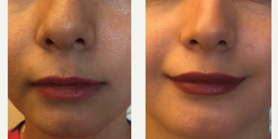 25-34 year old woman treated with Juvederm - The female patient has had Lip Filler procedure which was performed by DR. Ozge Ergun. The result of 5 days.