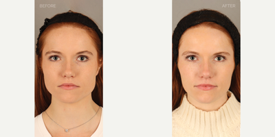 25-34 year old woman treated with Botox for TMJ, Botox, Jaw Reduction - 29-year-old female who presented complaining that her face had become more rectangular. On history, she reported significant grinding and clenching at night, requiring a night guard for tooth protection. She was diagnosed with masseter (chewing muscle) hypertrophy, as a result of this grinding and clenching, leading to the changes she noticed in her jaw. She is shown 6 weeks after neurotoxin (Botox) treatment to these muscles, resulting in jawline slimming and a more heart-shaped face. She also has complete relief from her symptoms related to teeth grinding and clenching.
