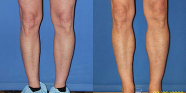 Calf Implant - 57 year old male ten months after medial calf augmentation (implants)