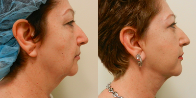 55-64 year old woman treated with Bilateral Upper Lid Blepharoplasty (Eyelid Surgery) - 55-64 year old woman treated with Bilateral Upper Lid Blepharoplasty (Eyelid Surgery)